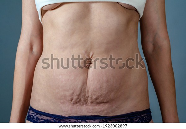 Stretch marks on a woman abdomen after childbirth.\
Deep scars, damaged\
skin.