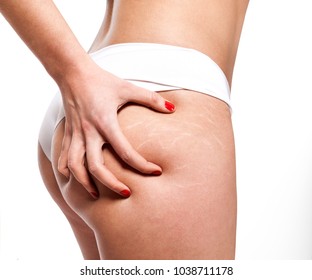 Stretch Marks On Woman's Buttocks. Skin Care Concept.