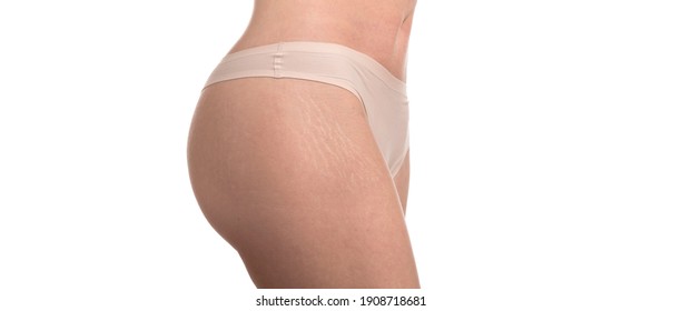 Stretch Marks On Woman's Buttocks. Skin Care Concept.