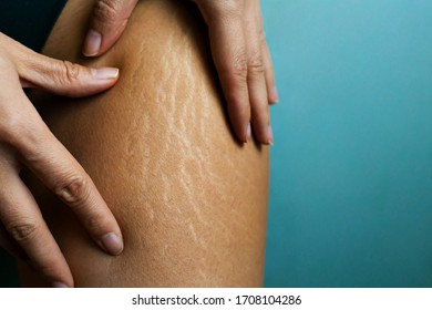 Stretch Marks On Woman's Legs. Female Hand Holds Fat Cellulite And Stretch Mark On Leg. Cellulite.