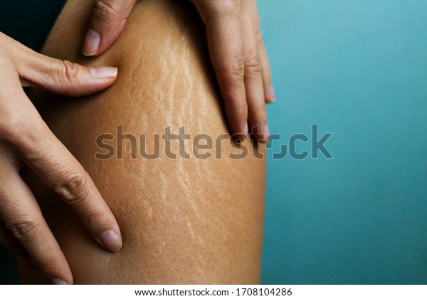Stretch Marks On Woman\'s Legs.\
Female Hand Holds Fat Cellulite And Stretch Mark On Leg.\
Cellulite.
