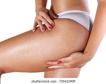 
Stretch Marks On Woman's Thighs And Buttocks 