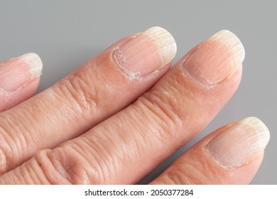 Striated, damaged, desiccated nails, close-up of woman's fingers