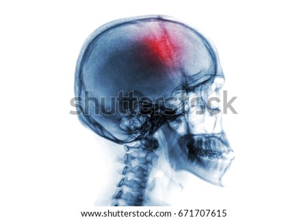Stroke . Cerebrovascular accident . Film x-ray of human skull and cervical spine .