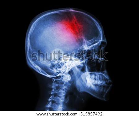 Stroke . film x-ray skull lateral view show human skull and stroke . cerebrovascular accident . isolated background