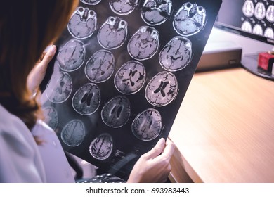 Stroke On MRI File 
Multiple Small Hemorrhagic 