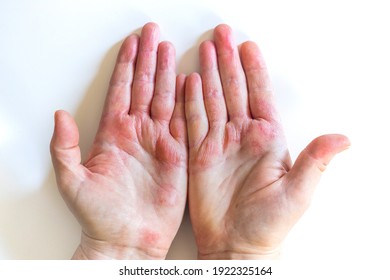 Strong allergic eczema on hands. Red, cracked skin with blisters