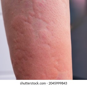 Strong Allergic Rashes On Body Impaired Stock Photo Shutterstock