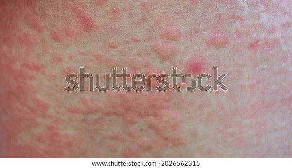 Strong Allergic Rashes On Body Impaired Stock Photo