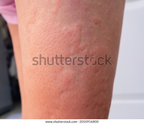 Strong Allergic Rashes On Body Impaired Stock Photo Shutterstock