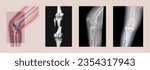 Structure of knee and rx-ray image of knee, tibia fracture with post operation internal fixation. Collage with illustration