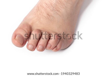 studio lighting. a human leg on a white background. The finger is strongly curved, deformed. Close-up