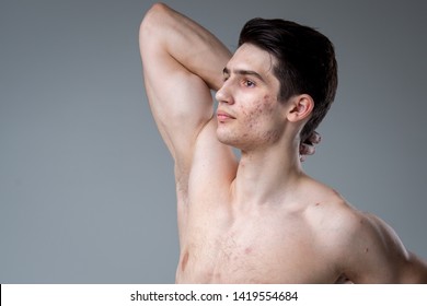 Studio portrait of a young brunette caucasian man on gray background posing. Puberty theme, problem skin, teen acne.
