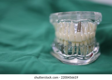 Study Model Of Human Tooth Anatomy With Medical Dental Implant Prosthesis For Education And Information To Patient In Dental Clinic Hospital By Dentist, Isolate Space With Green Background
