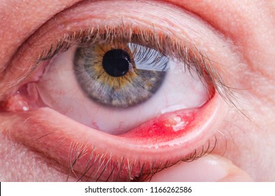 Stye (hordeolum) Disease On Eye Of A Caucasian Female