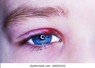 2,495 Barley on eye Images, Stock Photos & Vectors | Shutterstock