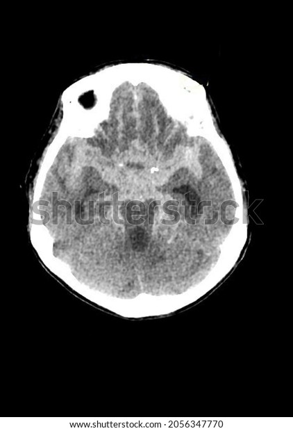 Subarachnoid Hemorrhage Ct Scan Radiology Stock Photo 2056347770 ...