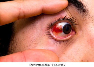 Subconjunctival Hemorrhage