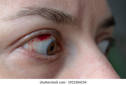 Subconjunctival Hemorrhage (broken Blood Vessel In Eye)