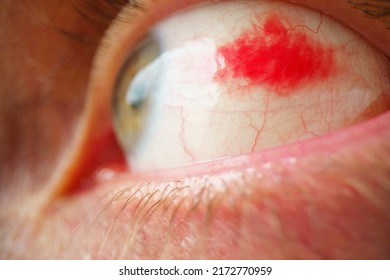 Subconjunctival Hemorrhage - Hyposphagma. Closeup Of Red Bloodshot Eye. Eye With Burst Blood Vessels Close Up