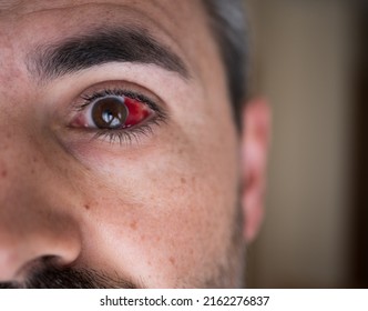 Subconjunctival Hemorrhage On Man Eye. Bloody Eye. Broken Blood Vessel