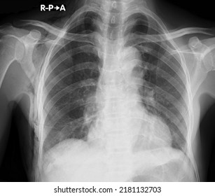 Subcutaneous Emphysema Chest X Ray Radiology Stock Photo 2181132703 ...