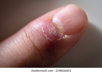 73,169 Infected Finger Images, Stock Photos & Vectors | Shutterstock