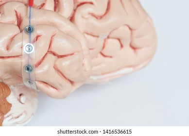 Subdural Grid Electrode For Brain Waves Recording Or Electroencephalography On The Side Of Artificial Brain Model Cortex Or Temporal Lobe