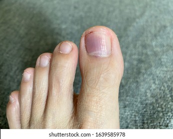 Subungual Hematoma Bleeding Under Toe Nail Stock Photo 1639585978 ...