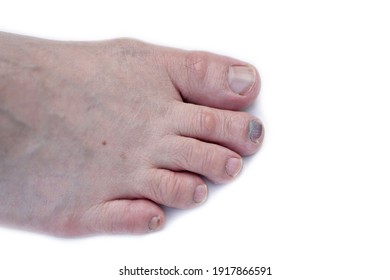 193 Subungual hematoma Images, Stock Photos & Vectors | Shutterstock