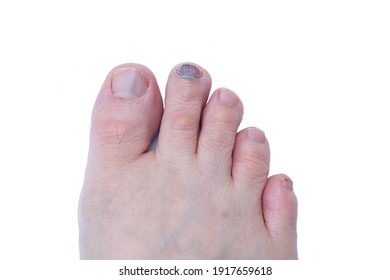 99 Blood under toe nail Images, Stock Photos & Vectors | Shutterstock