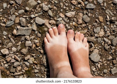 Summer. Children's Legs Of A Girl On The Background Of A Rocky Shore. There Are Sandal Marks From Sunburn On The Feet. Crooked Toe On One Leg.