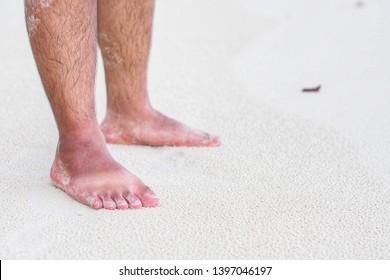 Summer Sun Can Scorch Your Feet - Sunburn