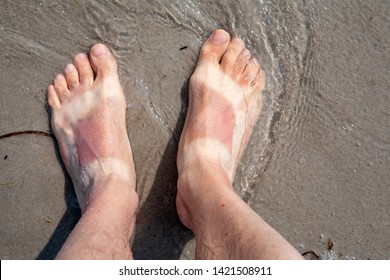 Sun burn feet with a sandals pattern burnt into the skin, cooling in the sea.