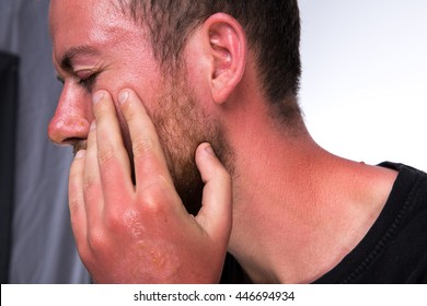 Sun Burn With Swelling And Blisters On The Skin Caucasian Men With Psoriasis On Light Background