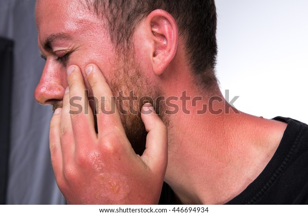 明るい背景に乾癬を持つ白人男性の皮膚に 膨らみと水疱を持つ日焼け の写真素材 今すぐ編集