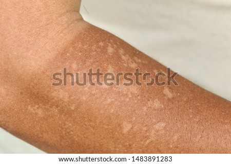 Sun damaged skin. Skin peeling from sunburn. Uneven skin tone of asian men arm.