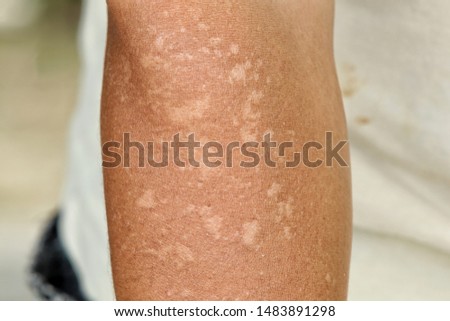Sun damaged skin. Skin peeling from sunburn. Uneven skin tone of asian men arm.