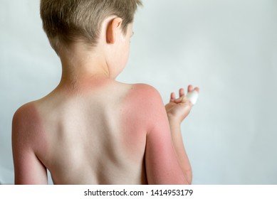 Sunblock For The Child. A Strong Sunburn From The Boy's Sun. Strong Tan In A Child. Therapeutic Protection Cream.skincare