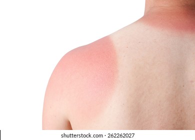 	Sunburn