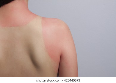 Sunburn