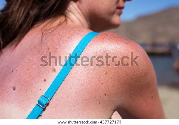 白人の女の子の肩と背中のビーチ サン ライトの日焼け 夏の休暇中の休暇中のビーチの女性 皮膚がんに対する意識 の写真素材 今すぐ編集