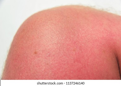 Sunburn. Burnt skin from the sun. Blisters on the leg of a man. Red Leather