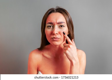 Sunburn Concept. A Young Woman Points A Finger At A Face Reddened By Sunburn. Gray Background. Copy