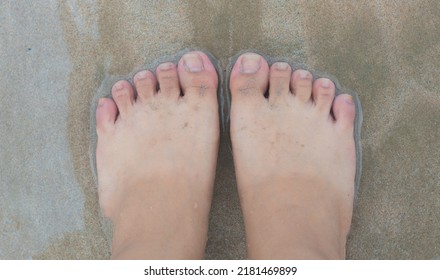 Sunburn Feet On The Sandy Beach