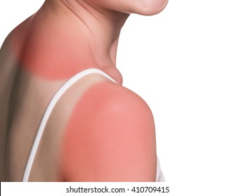 Sunburn Female Shoulder 