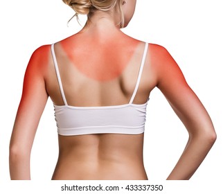 Sunburn Female Shoulder