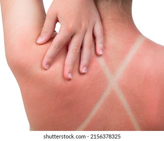 Sunburn. Girl got a Sunburn. Red painful skin on back that feels hot to the touch after beach visits. Use Sunscreen or UV protection cream. Summer vacation on ocean beach. White Isolated background.