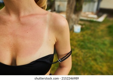 Sunburn On The Chest And Shoulders Of A Caucasian Girl Resting In The Summer. Burnt Female Skin In The Sun Close-up In A Black Swimsuit. Burnt Female Skin In The Sun.