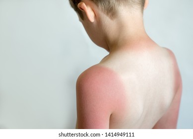 Sunburn On A Child's Back. Strong Tan In The Boy. Red Hands And Back. Sore Skin, Blistered. No Sun Protection